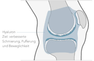 Hyaluronsäure, regenerative Therapie für Gelenke